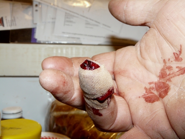 FingerInjury-1.jpg