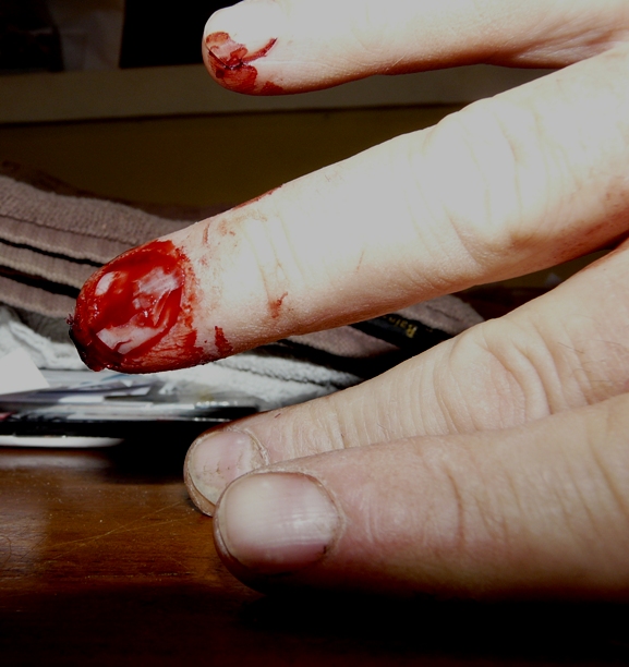 FingerInjury-2.jpg