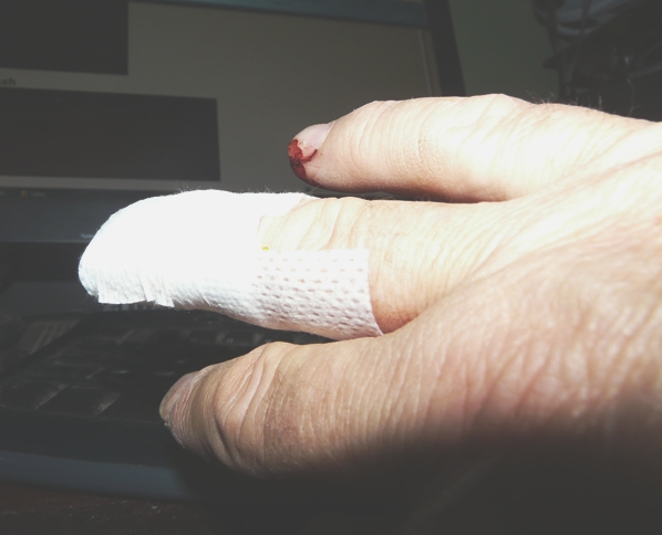 FingerInjury-3.jpg